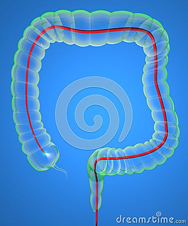 Colonoscopy and probe Stock Photo