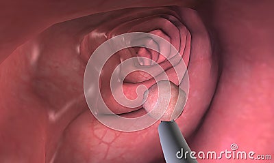 Colonoscopy is a procedure that allows you to see inside your entire large intestine Stock Photo