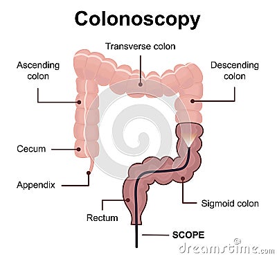 Colonoscopy technology concept with rendering endoscope inside of intestine Vector Illustration