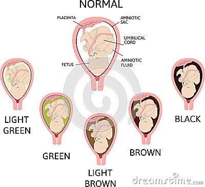 Color of amniotic fluid in the amniotic sac. normal and danger variants. Vector Illustration