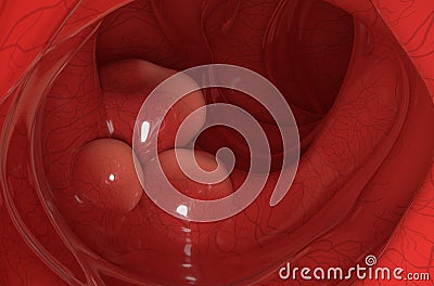 Large tumors on the colon wall in colorectal cancer closeup view 3d illustration Stock Photo