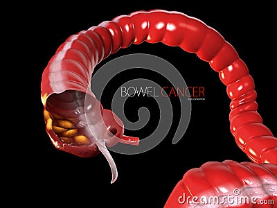 Colorectal cancer, isolated black background 3d Illustration Stock Photo