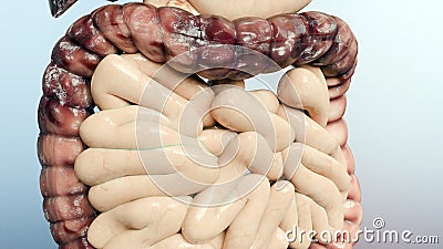 Colorectal cancer, malignant tumor in intestine, Endoscope inside colonoscopy, gut intestine, Colon polyp removal, Stock Photo