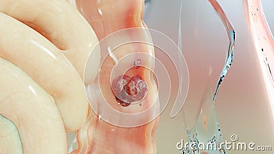 Colorectal cancer, malignant tumor in intestine, Endoscope inside colonoscopy, gut intestine, Colon Polypectomy Stock Photo