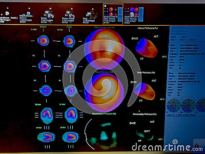 Color adenosine cardiac stress test images on black background Stock Photo