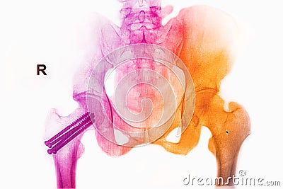 Colorful pelvis x-rays image Stock Photo