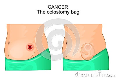 A colostomy bag after operation of colostomy Vector Illustration