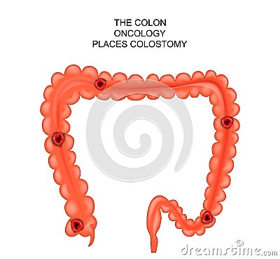 Colostomy. place surgical intervention Vector Illustration