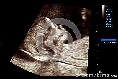 Colourful image of pregnancy ultrasound monitor Stock Photo