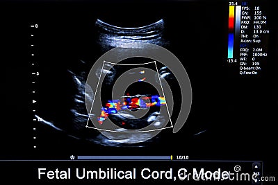 Colourful image of pregnancy ultrasound monitor Stock Photo