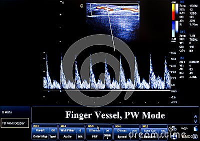 Colourful ultrasound monitor image. Finger Vessel Stock Photo