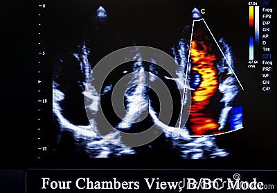 Colourful ultrasound monitor image. Four Chambers View Stock Photo