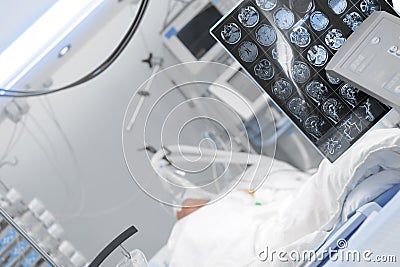 Comatose patient on the lung ventilator in the intensive care un Stock Photo