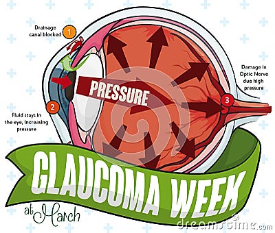 Commemorative Infographic for Glaucoma Week Celebration, Vector Illustration Vector Illustration