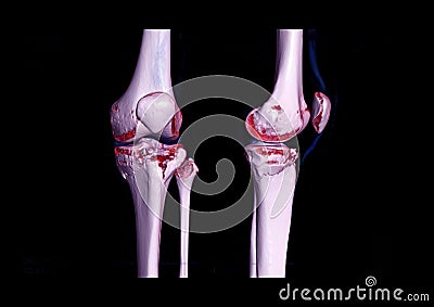 Compare AP and lateral view of CT knee joint 3D rendering image showing fracture tibia bone Stock Photo