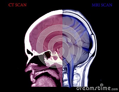 Compare CT Brain and MRI Brain sagittal view . Stock Photo