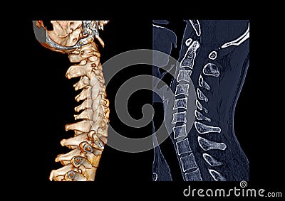 Compare of CT C-Spine or Cervical spine 3D Rendering image and sagittal Stock Photo