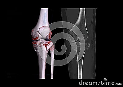 Compare of CT knee joint 3D rendering image and CT knee 2D Coronal view isolated on black background showing fracture tibia bone Stock Photo