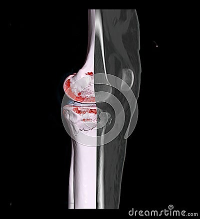 Compare of CT knee joint 3D rendering image and CT knee 2D isolated on black background showing fracture tibia bone Stock Photo