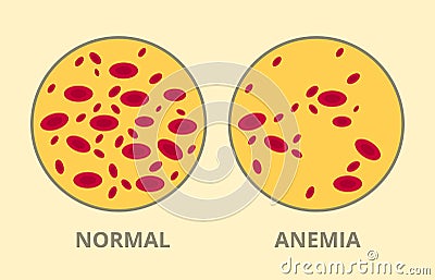 Compare between normal blood cell vs anemia disease sick Vector Illustration