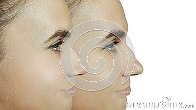 Comparison of the female nose after rhinoplasty plastic surgery Stock Photo