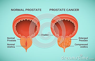 Comparison of Healthy and Cancer Prostate illustration Vector Illustration