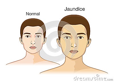 The Comparison between normal skin people and yellowing from Jaundice. Vector Illustration