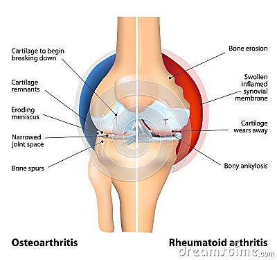 Comparison of Osteoarthritis and Rheumatoid Arthritis Vector Illustration