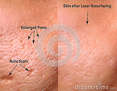 Comparison of skin before and after laser resurfacing. Skin with acne, acne scars, enlarged pores. Stock Photo