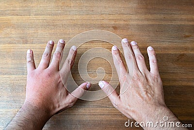 Comparison of two male hands stung by bee or wasp. Hand swelling, inflammation, redness are signs of infection. Insect bite on Stock Photo