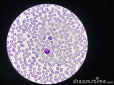 Comparison white blood cell Eosinophil and Neutrophil Stock Photo