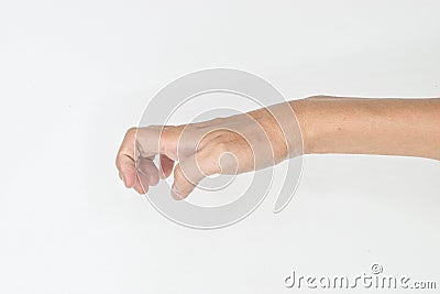 Complete claw hand abnormality Stock Photo