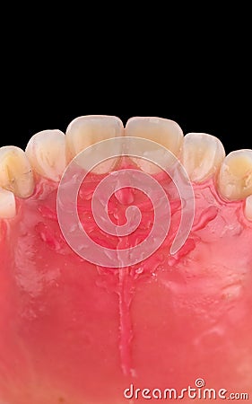 Complete maxillary denture â€“ Wax-Up and Gingival Contouring Stock Photo