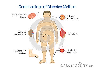 Complications of Diabetes Mellitus. Vector Illustration