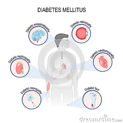 Complications of diabetes mellitus Vector Illustration