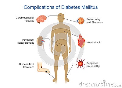 Complications of Diabetes Mellitus. Vector Illustration