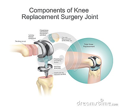 Components of knee replacement surgery joint. Stock Photo