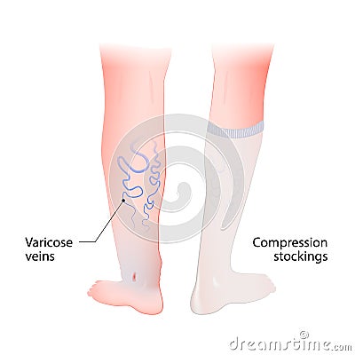 Compression stockings for varicose veins Vector Illustration