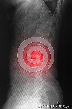 Radiography CR of lumbosarcal spine lateral showing spondylosis and scoliosis spine. Stock Photo