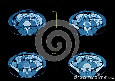 Computed tomography of the chest. Stock Photo