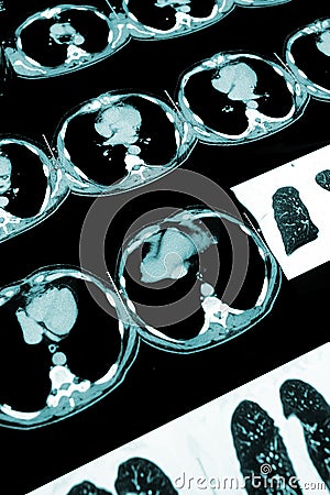 Computed tomography (CT) of the thoracic Stock Photo