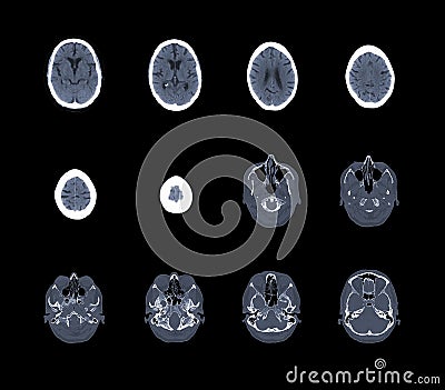 Computed tomography of head and brain Stock Photo