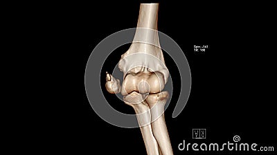 Computed Tomography Volume Rendering examination of the Elbow joint CT VR Elbow showing fracture of the medial epicondyle Stock Photo