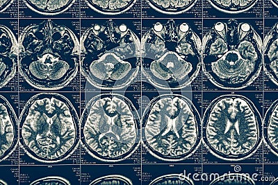 Computer tomography X-Ray brain scan image, internal hydrocephalus, neurology Stock Photo