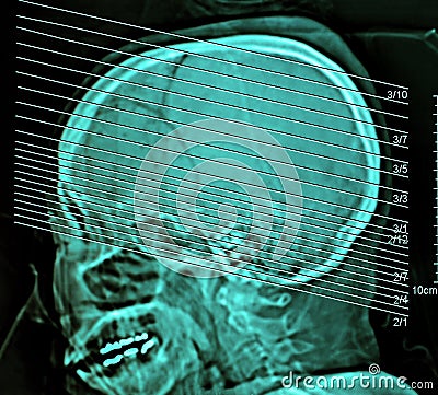 Computerized film x-ray tomography of human brain, CT Scan Stock Photo