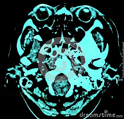 Computerized film x-ray tomography of human brain, CT Scan Stock Photo