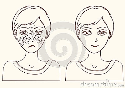 Concept for girl remove freckles outline. Vector Illustration