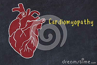 Concept of learning cardiovascular system. Chalk drawing of human heart and inscription Cardiomyopathy Stock Photo