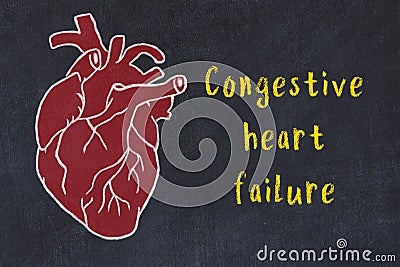 Chalk sketch of human heart on black desc and inscription Congestive heart failure Stock Photo