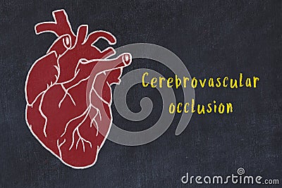 Concept of learning cardiovascular system. Chalk drawing of human heart and inscription Cerebrovascular occlusion Stock Photo